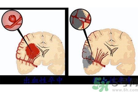 腦出血的發(fā)病因素是什么？腦出血的并發(fā)癥有哪些？
