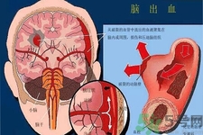 腦出血的發(fā)病因素是什么？腦出血的并發(fā)癥有哪些？