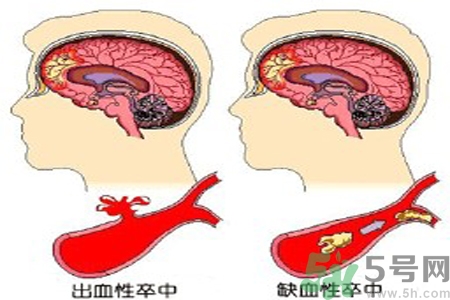腦出血的治療方法是什么？腦出血可以用哪些藥物治療？