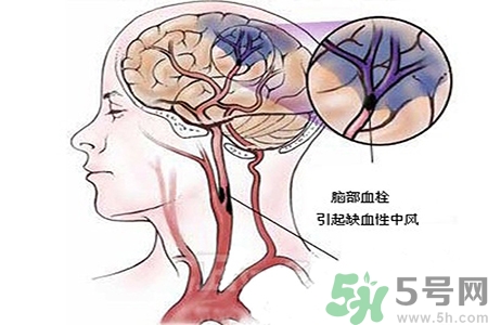 腦出血的治療方法是什么？腦出血可以用哪些藥物治療？