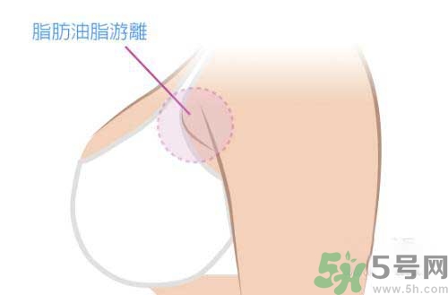 副乳是什么？副乳的危害