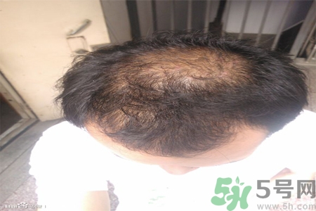 脫發(fā)的措施有什么？脫發(fā)的注意飲食有哪些？