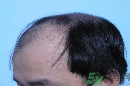 脫發(fā)的措施有什么？脫發(fā)的注意飲食有哪些？