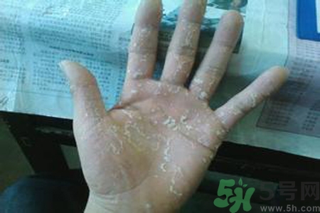 引起手足癬的主要原因？手足癬會(huì)引發(fā)什么疾??？