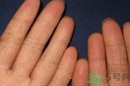手足癬的治療方法？治療手足癬可以用什么藥？