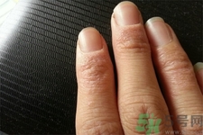 手足癬的治療方法？治療手足癬可以用什么藥？