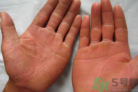 手足癬的治療方法？治療手足癬可以用什么藥？