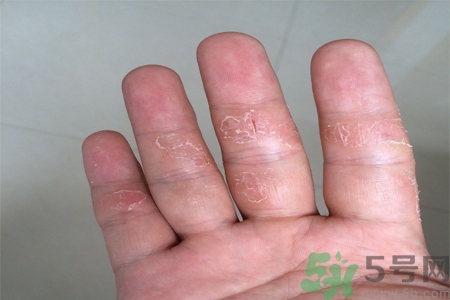 手足癬的易發(fā)人群有哪些？如何預(yù)防手足癬？