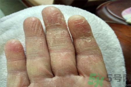 手足癬會傳染嗎？手足癬的傳播途徑有哪些？