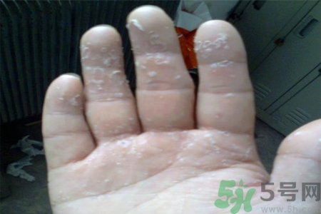 手足癬會傳染嗎？手足癬的傳播途徑有哪些？