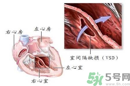 心臟病是怎么形成的？易發(fā)人群有哪些？