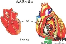 心臟病的癥狀是什么？心臟病的種類有哪些？