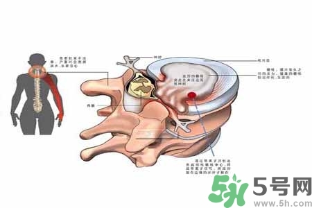 為什么年輕人容易得頸椎病？頸椎病嚴重的癥狀有哪些？