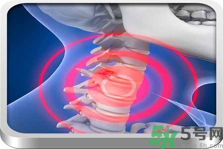 為什么年輕人容易得頸椎?。款i椎病嚴重的癥狀有哪些？
