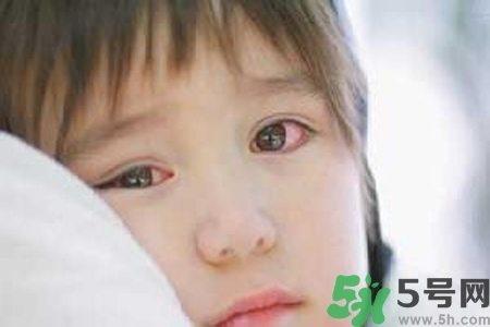 寶寶為什么會(huì)感染紅眼??？寶寶患紅眼病如何治療？