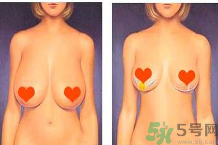 ?女性乳房下垂的原因是什么？女性乳房下垂的分類有哪些？
