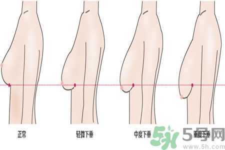 ?女性乳房下垂的原因是什么？女性乳房下垂的分類有哪些？
