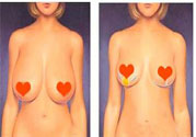 ?女性乳房下垂的原因是什么？女性乳房下垂的分類有哪些？