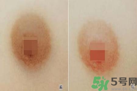 乳頭發(fā)黑怎么辦？怎么樣可以使乳頭變白？