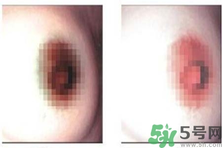 乳頭發(fā)黑怎么辦？怎么樣可以使乳頭變白？