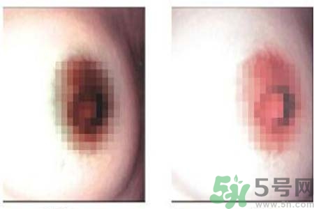 乳頭發(fā)黑是怎么回事？乳頭發(fā)黑是什么原因？
