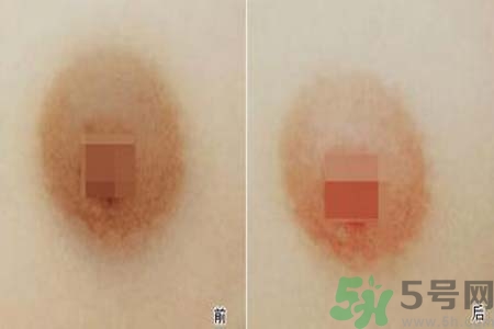 乳頭發(fā)黑是怎么回事？乳頭發(fā)黑是什么原因？