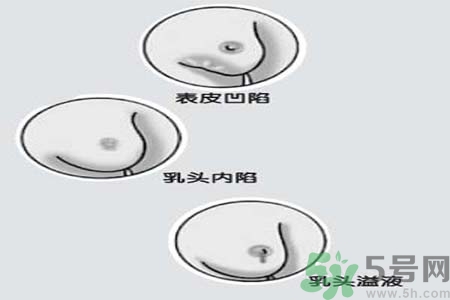乳頭內(nèi)陷怎么回事？乳頭內(nèi)陷的原因是什么？