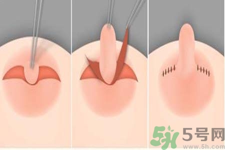 乳頭內(nèi)陷怎么回事？乳頭內(nèi)陷的原因是什么？