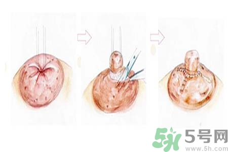 乳頭內(nèi)陷怎么回事？乳頭內(nèi)陷的原因是什么？