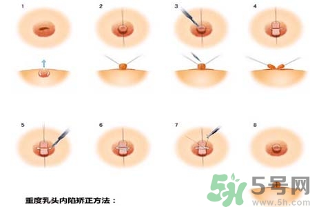乳頭內(nèi)陷怎么回事？乳頭內(nèi)陷的原因是什么？