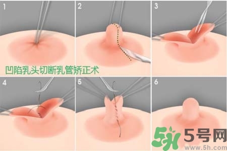 乳頭內(nèi)陷怎么辦？乳頭內(nèi)陷的癥狀有哪些？