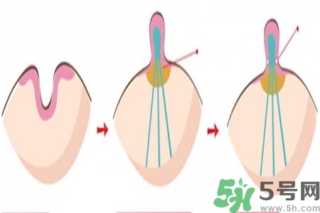 乳頭內(nèi)陷怎么辦？乳頭內(nèi)陷的癥狀有哪些？