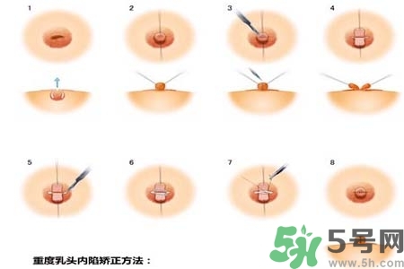 乳頭內(nèi)陷怎么辦？乳頭內(nèi)陷的癥狀有哪些？
