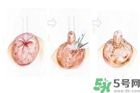 乳頭內(nèi)陷怎么辦？乳頭內(nèi)陷的癥狀有哪些？