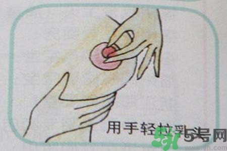 乳頭內(nèi)陷怎么辦？乳頭內(nèi)陷的癥狀有哪些？