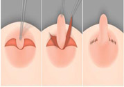 乳頭內(nèi)陷怎么辦？乳頭內(nèi)陷的癥狀有哪些？