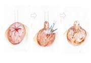 乳頭內(nèi)陷矯正需注意什么？乳頭內(nèi)陷如何預(yù)防？