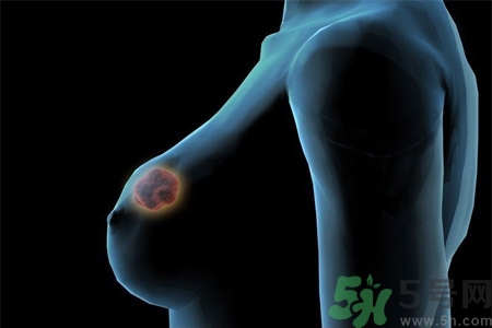 乳房屋硬塊有疼痛感怎么回事？乳房屋硬塊有疼痛感怎么辦？