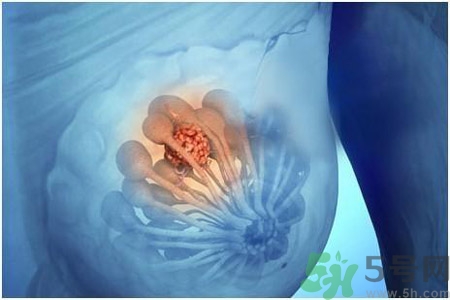 乳房屋硬塊有疼痛感怎么回事？乳房屋硬塊有疼痛感怎么辦？
