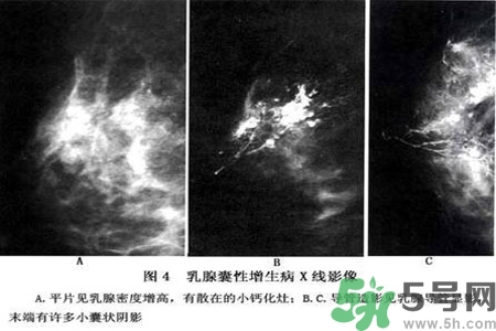 產(chǎn)生乳腺增生鈣化的病因是什么？乳腺增生怎樣治療？
