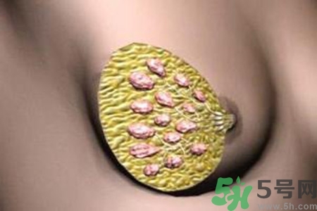 乳腺增生鈣化是什么？乳腺鈣化的癥狀有哪些？