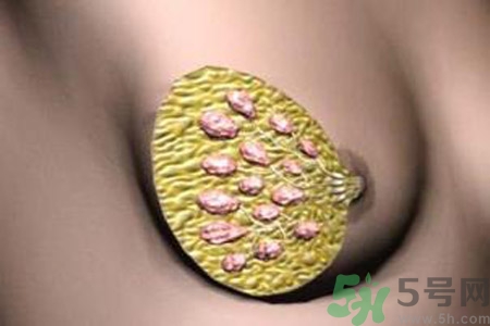 產(chǎn)生乳腺增生鈣化的病因是什么？乳腺增生怎樣治療？