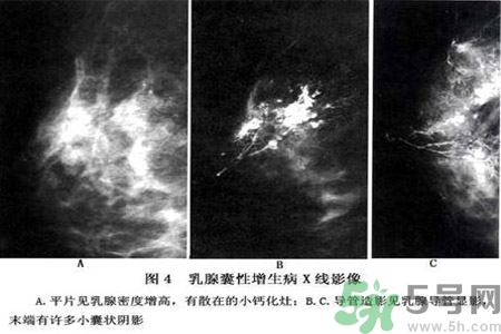 乳腺增生鈣化是什么？乳腺鈣化的癥狀有哪些？