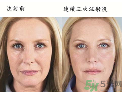 3D液態(tài)拉皮多少錢？3D液態(tài)拉皮后多久見效？