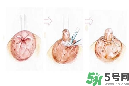 乳頭內(nèi)陷怎么矯正？乳頭內(nèi)陷矯正方法是什么？