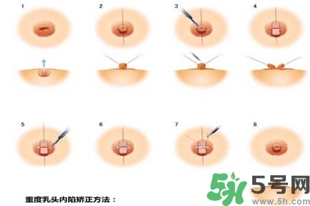 乳頭內(nèi)陷怎么矯正？乳頭內(nèi)陷矯正方法是什么？
