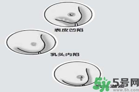 乳頭內(nèi)陷怎么矯正？乳頭內(nèi)陷矯正方法是什么？