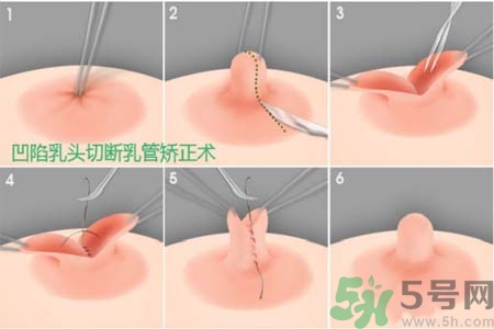 乳頭內(nèi)陷怎么矯正？乳頭內(nèi)陷矯正方法是什么？