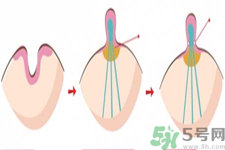 乳頭內(nèi)陷矯正需注意什么？乳頭內(nèi)陷如何預(yù)防？