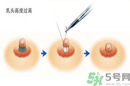 乳頭內(nèi)陷能不能喂奶？乳頭凹陷怎樣哺乳？